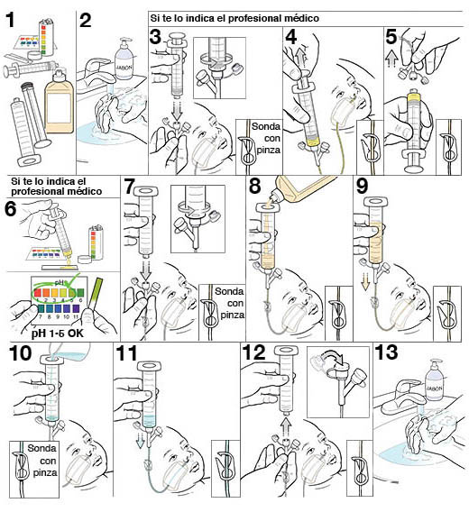 13 pasos para alimentar a un bebé con una sonda nasogástrica.