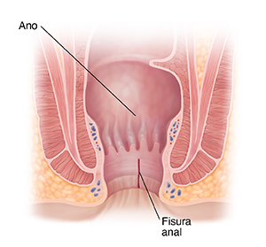 Corte transversal de ano con una fisura anal.